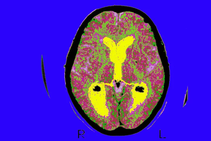 How a Japanese Drugmaker Clinched Win Over Alzheimer’s