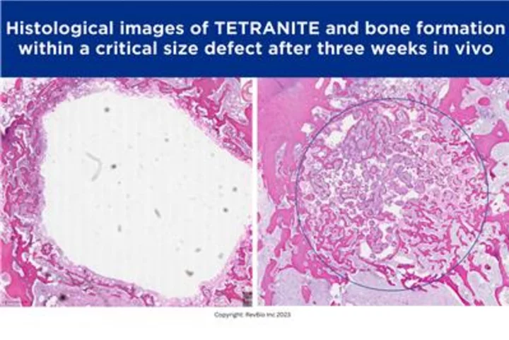 RevBio Receives FDA Approval to Conduct its Second U.S.-Based Clinical Trial for Dental Implant Stabilization