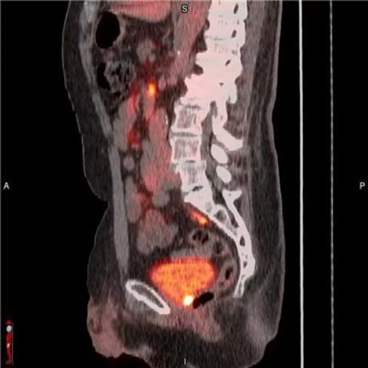 New Data on POSLUMA® (Flotufolastat F 18) in Patients with Suspected Biochemical Recurrence of Prostate Cancer and Low-Very Low Prostate Specific Antigen (PSA) Levels Presented at ASTRO