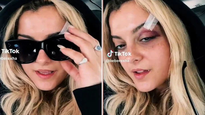 Bebe Rexha shares black eye update after being hit in face by phone during concert