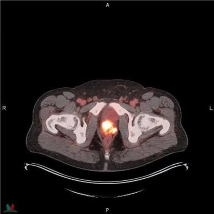 U.S. FDA Approves Blue Earth Diagnostics’ POSLUMA® (Flotufolastat F 18) Injection, First Radiohybrid PSMA-targeted PET Imaging Agent for Prostate Cancer